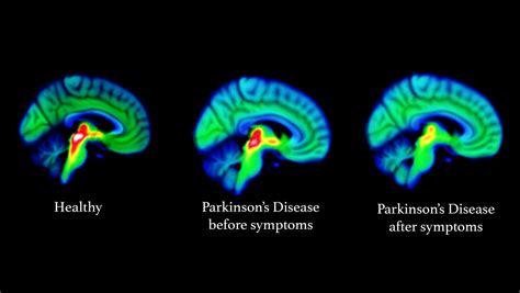 パーキンソン病 人格障害 - 脳の迷宮を彷徨う影